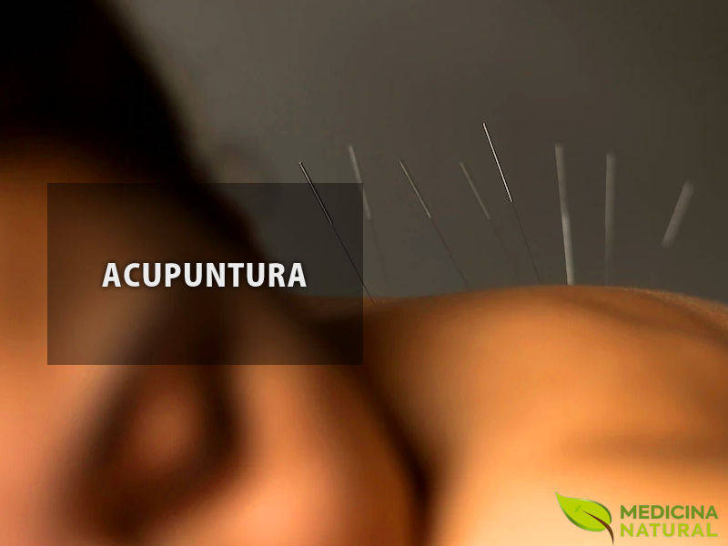 Acupuntura