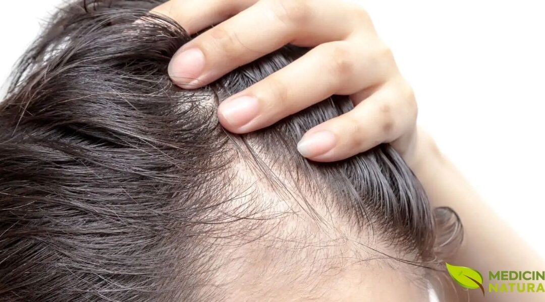 Tratamento Natural para Calvície: O Fim da Queda de Cabelo
