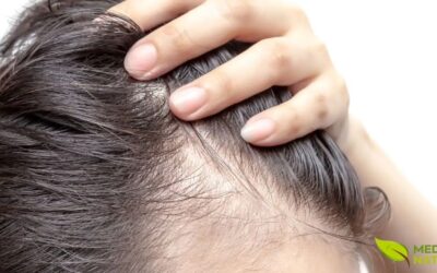 Tratamento Natural para Calvície: O Fim da Queda de Cabelo