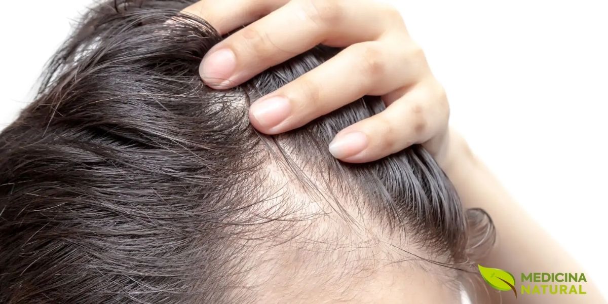 A forma mais comum de calvície é a chamada alopecia androgenética, que ocorre em seres humanos adultos do sexo masculino. A quantidade e os padrões de calvície pode variar bastante em homens e mulheres e incluem a alopecia androgenética, alopecia areata, alopecia universalis, alopecia totalis (perda total de todos os pelos do corpo), dentre outras.