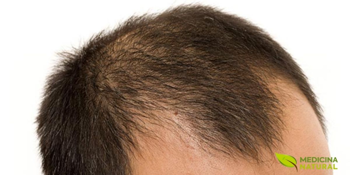 Fotografia mostrando o padrão típico da alopecia androgenética masculina, com retração da linha frontal e adelgaçamento no topo do couro cabeludo. Este é o tipo mais comum de calvície em homens, causado pela sensibilidade dos folículos capilares ao hormônio DHT (di-hidrotestosterona), resultando na miniaturização progressiva dos fios. Fonte: Cleveland Clinic.