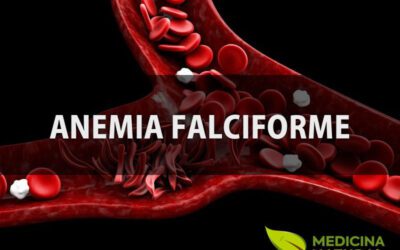 Anemia falciforme: tratamentos naturais