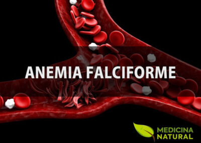 Anemia falciforme