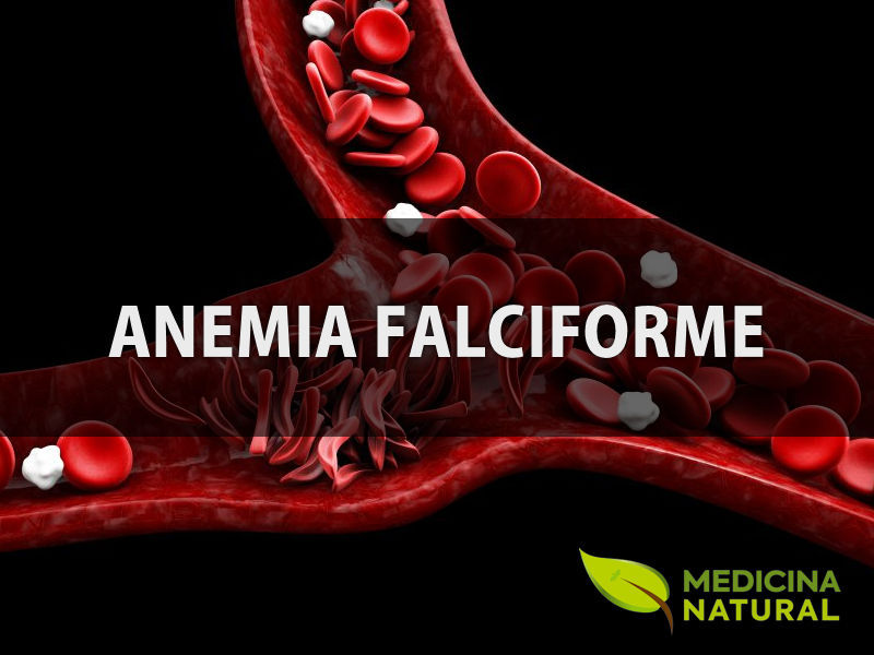 Anemia falciforme