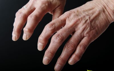 Artrose: sintomas e tratamento natural
