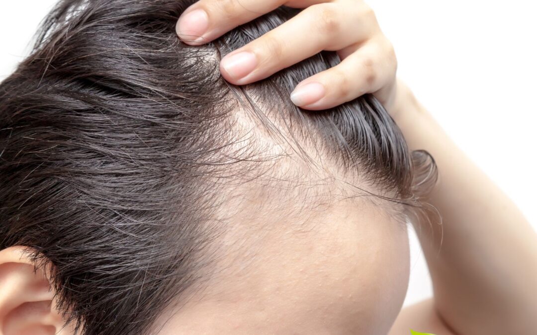 Calvície: causas e tratamento natural para a queda de cabelo