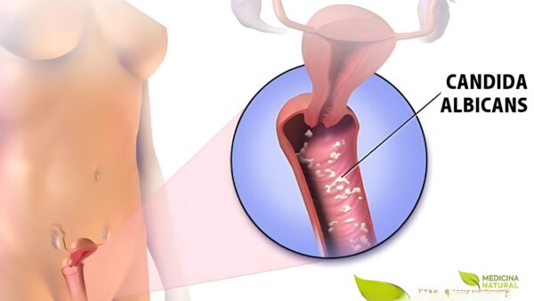 Candidíase vaginal