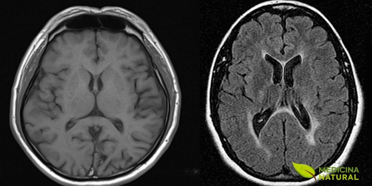 A esclerose múltipla afeta o sistema nervoso central, causando danos à bainha de mielina. O dimetilfumarato, derivado do ácido fumárico, foi aprovado como tratamento oral eficaz para formas recorrentes desta doença neurológica debilitante.