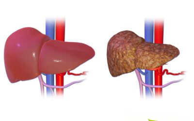 Cirrose hepática: causas e tratamento