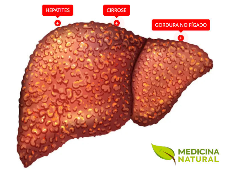 Fígado Doente