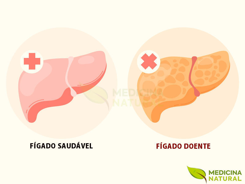 Fígado Saudável x Fígado Doente