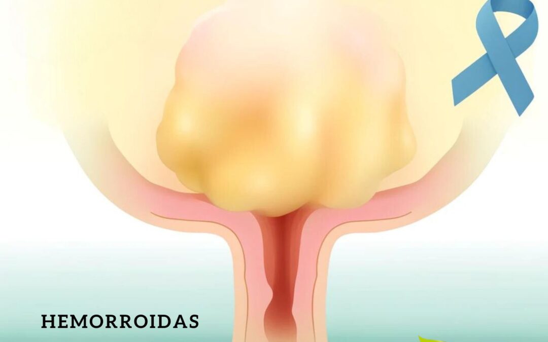 Hemorroidas: veja remédios naturais e terapias para tratar