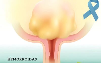 Hemorroidas: veja remédios naturais e terapias para tratar