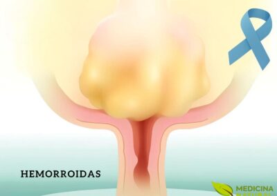 Hemorroidas