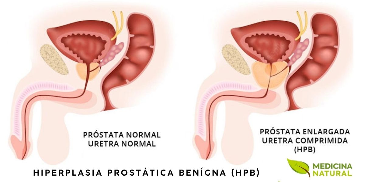 Ensaios clínicos têm mostrado que o extrato de saw palmetto utilizado no período de 4 a 6 semanas já começa a mostrar resultados eficazes em até 90% dos homens com prostatite, HPB e outras condições da próstata. Já os medicamentos comuns têm demonstrado a necessidade até um ano para melhorias significativas. Outra vantagem é que o preço do extrato de saw palmetto é cerca de um quarto do preço de vários outros medicamentos para próstata, segundo o Prostate Cancer and Diet, site especializado em nutrição e cuidados com a alimentação.