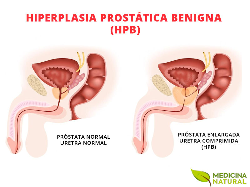 Hiperplasia Prostática Benigna (HPB)