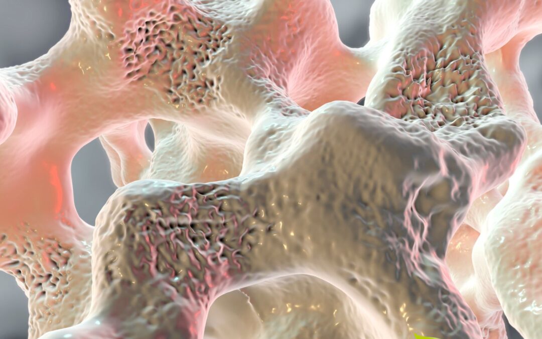 Osteoporose: causas, sintomas, tratamento