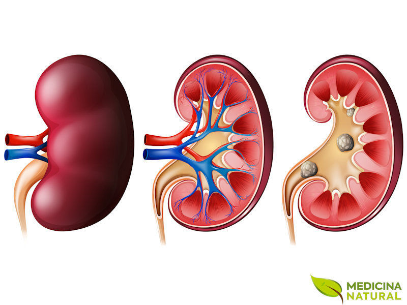 Pedras nos Rins