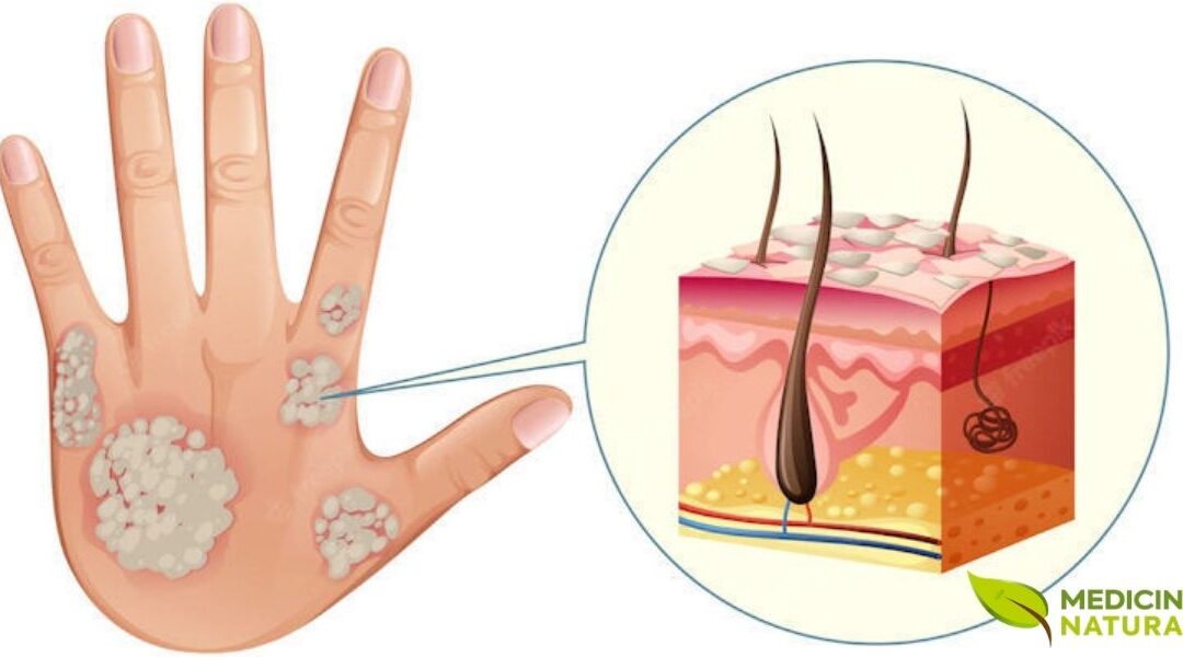 Psoríase: Como Aliviar os Sintomas com Tratamentos Naturais