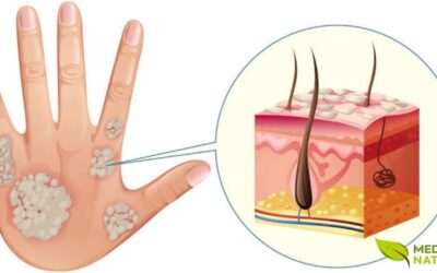 Psoríase: Como Aliviar os Sintomas com Tratamentos Naturais