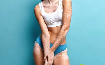 Vitiligo: melhores tratamentos naturais