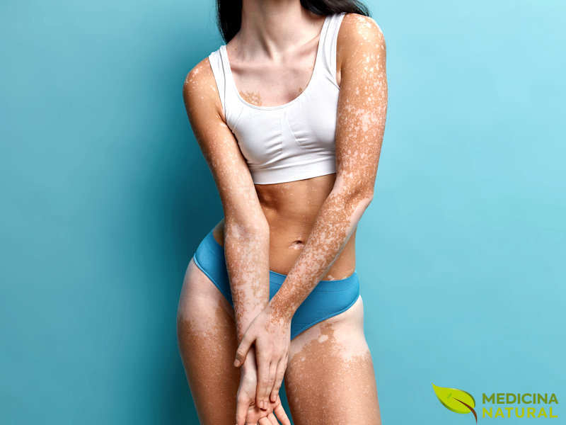 Vitiligo